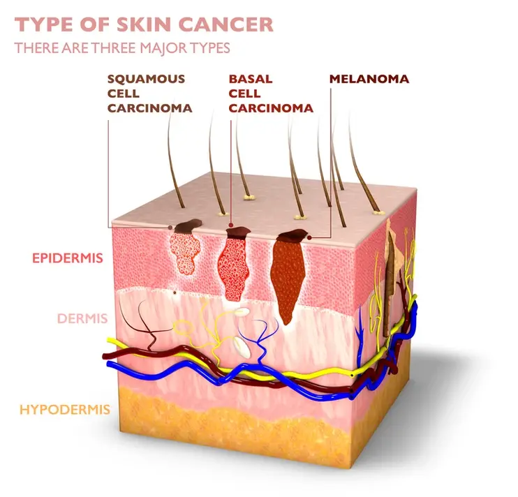 A medical illustration showing a cross-section of skin layers (epidermis, dermis, and hypodermis) with labels indicating three major types of skin cancer: squamous cell carcinoma, basal cell carcinoma, and melanoma, along with the affected areas.