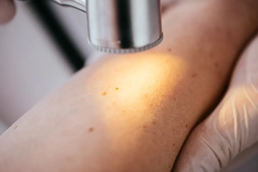 A close-up of a medical professional using a dermatoscope to examine moles on a person's arm. The skin has several small moles, and the professional is wearing gloves, highlighting a careful and sterile procedure aimed at detecting early signs of skin cancer.