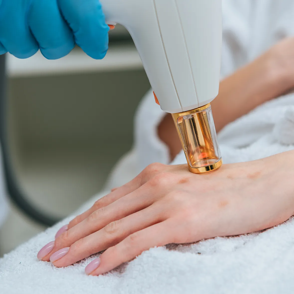 A hand is undergoing a laser treatment. The hand is resting on a white towel, and a medical professional wearing blue gloves is holding a laser device aimed at the back of the hand. The scene appears to be in a clinical or spa setting.