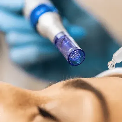 Close-up of a person's forehead being treated with a blue-tipped microneedling device and a dropper applying a serum. The individual administering the treatment is wearing blue gloves.