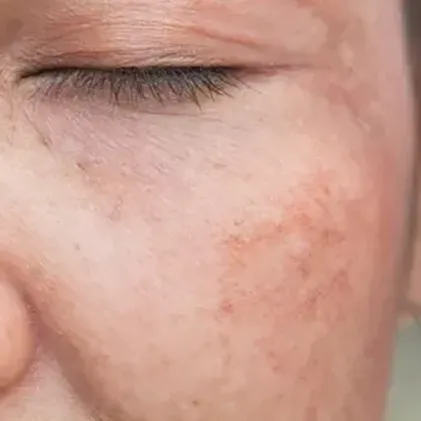 Close-up image of a person's face showing their closed eye and cheeks. The skin appears uneven in tone, with visible patches of discoloration and spots, indicative of conditions such as hyperpigmentation or scars. The person's eyelashes are short and sparse.