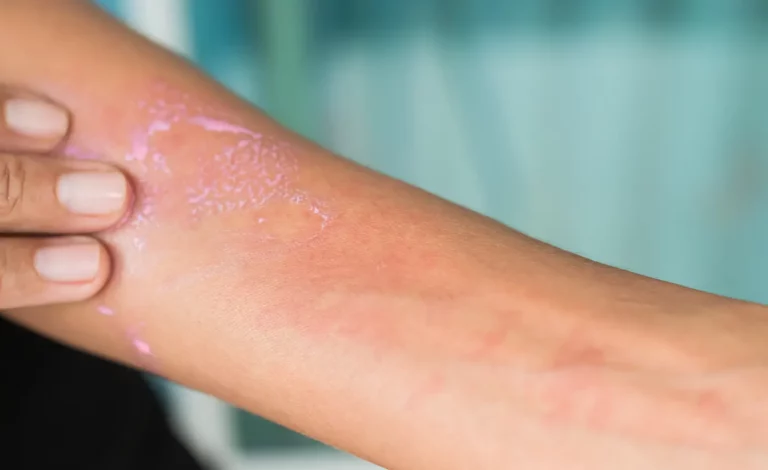A close-up of a person’s arm shows a patch of irritated, red skin typical of psoriasis. The area appears dry and flaky, and the person is gently touching it with their other hand. The background is blurred, focusing attention on the skin condition.