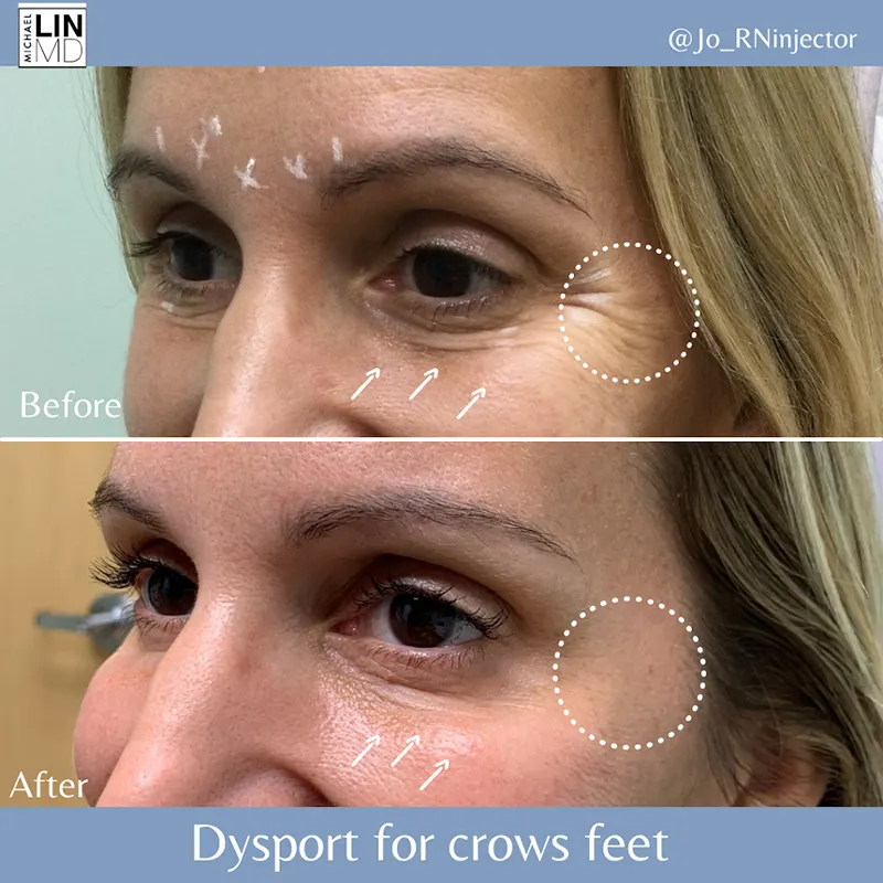 Close-up images show a woman's eye area before and after Dysport injections for crow's feet. The top image highlights wrinkles with arrows, while the bottom image shows smoother skin with reduced wrinkles. Text reads 'Before' and 'After.' Images courtesy of Unified Health.