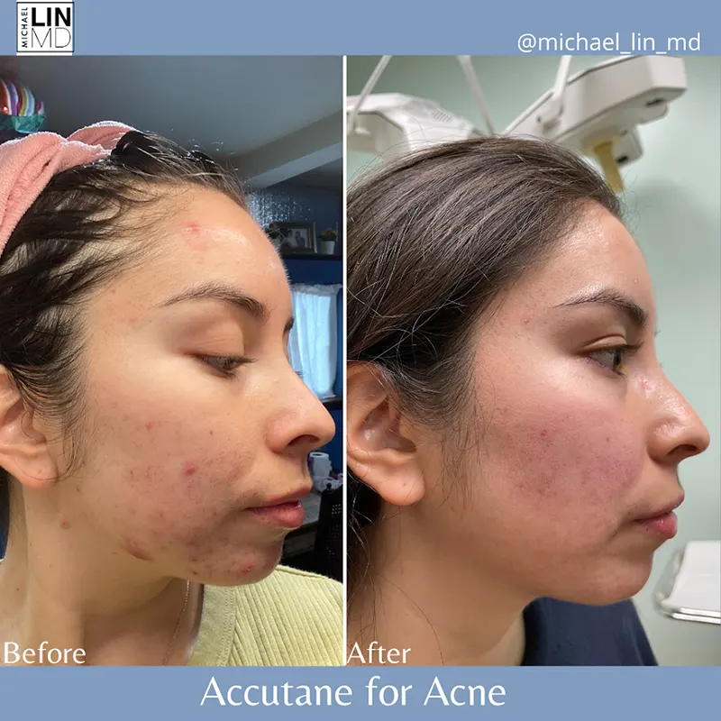 Side-by-side comparison of a woman’s face, showing improvement in acne after using Accutane from Unified Health. The left image is labeled "Before" and shows more acne and blemishes. The right image is labeled "After" and shows clearer skin with significantly reduced acne.