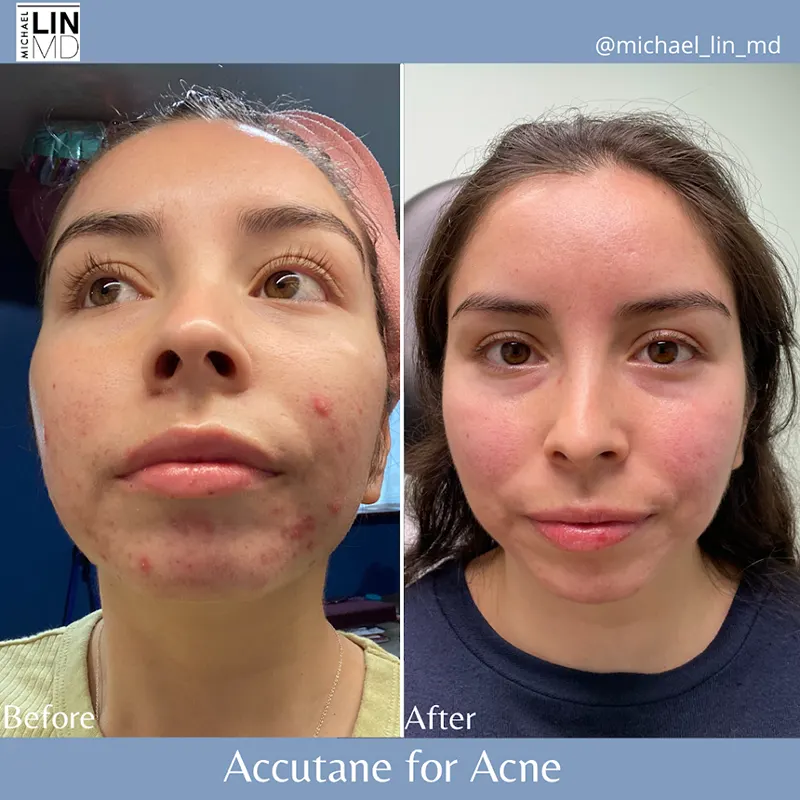 Side-by-side comparison image showing a person's face before and after using Accutane for acne. The left side, labeled "Before," shows noticeable acne, while the right side, labeled "After," reveals significantly clearer skin with some residual redness. Text: "Accutane for Acne - Unified Health.