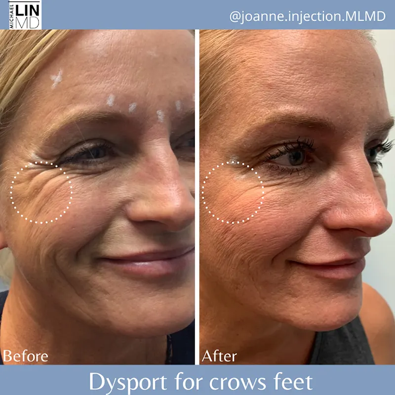 Side-by-side comparison of a woman's face before and after Dysport treatment for crow's feet. The left image shows noticeable wrinkles around her eyes, while the right image shows a reduction in these wrinkles. Text at the bottom reads, "Dysport for crows feet," provided by Unified Health.