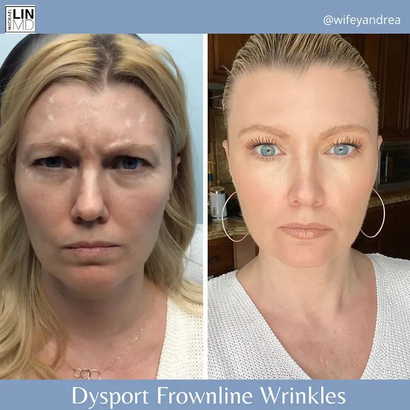 Side-by-side comparison of a woman's face before and after Dysport treatment for frown lines and wrinkles. The left image shows her with pronounced frown lines and a furrowed brow, while the right image shows a smoother forehead and relaxed expression. Unified Health Text: "Dysport Frownline Wrinkles.