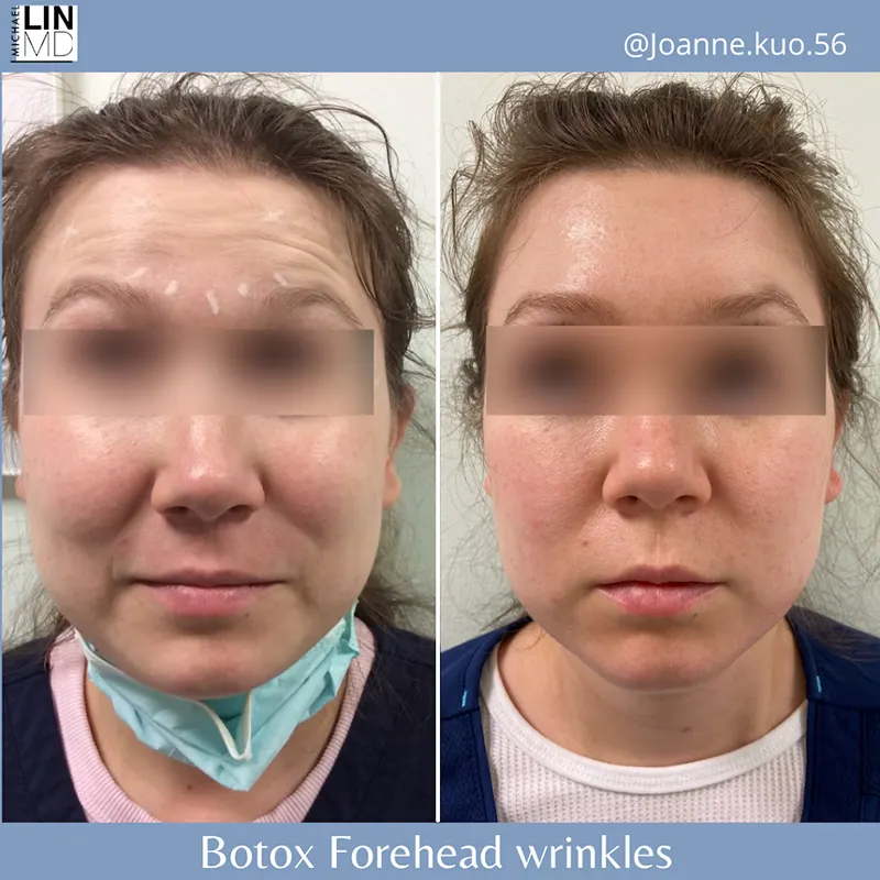 Side-by-side images show a woman's face before and after Botox treatment for forehead wrinkles. In the before image, her forehead appears wrinkled, with a face mask under her chin. The after image, reflecting Unified Health standards, reveals a smoother forehead.