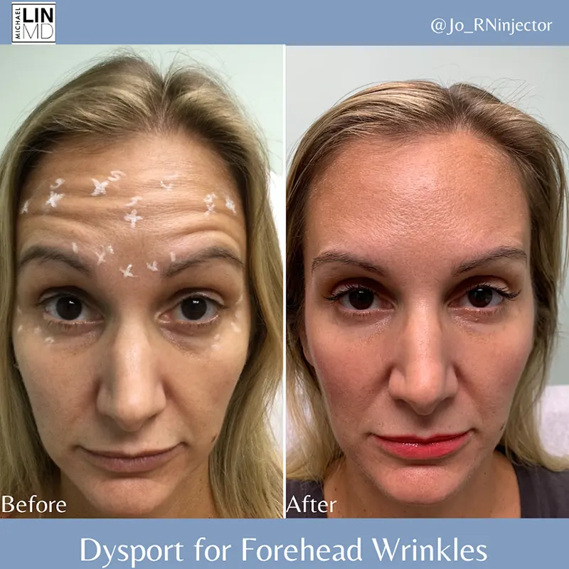 Side-by-side images show a woman's face before and after receiving Dysport for forehead wrinkles. The "before" image has marks on her forehead indicating treatment areas. The "after" image shows a smoother forehead with fewer wrinkles. Text: "Dysport for Forehead Wrinkles by Unified Health".