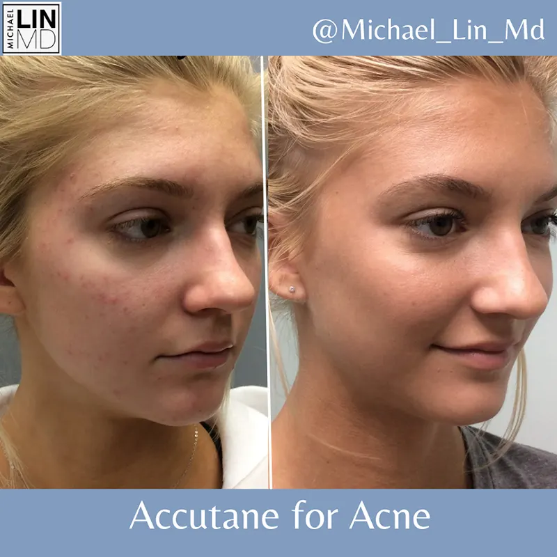 Before and after photos showing the effects of Accutane on a young woman's acne. The left image displays acne and skin redness, while the right image shows clear and smooth skin. The text reads "@Michael_Lin_Md," "Unified Health," and "Accutane for Acne.