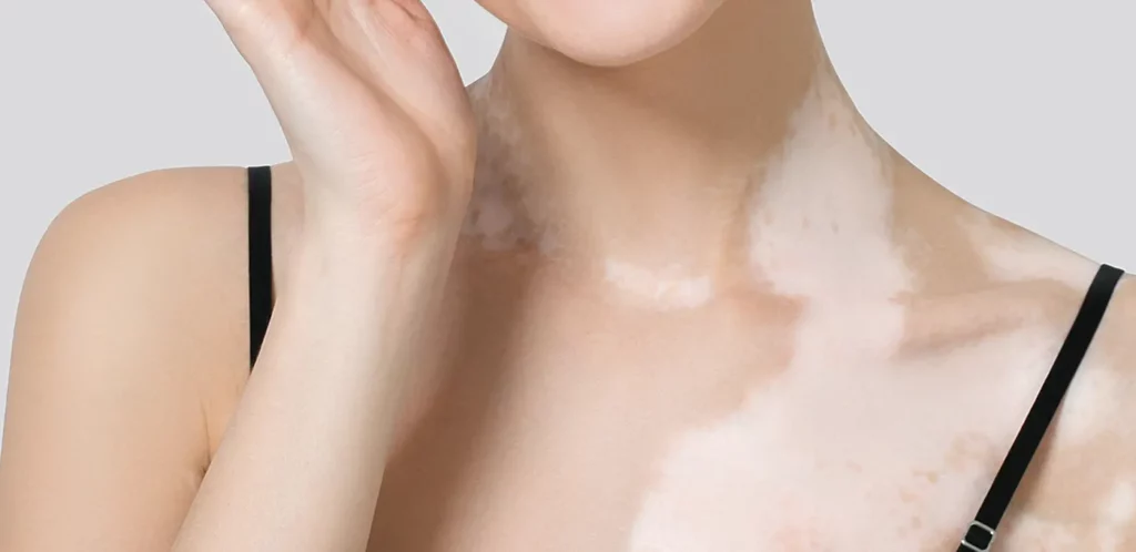 A close-up of a person with vitiligo, displaying areas of depigmented skin on their neck and part of their shoulder. The individual, wearing a thin black strap top, touches their face with one hand. The plain, light gray background draws focus to their skin, highlighting the need for vitiligo treatment.